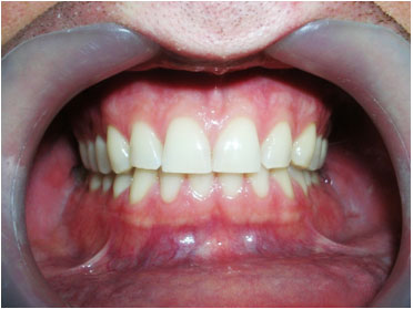 Diastema-na